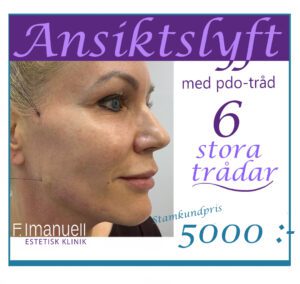 Ansiktslyft med PDO-trådar