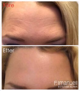 Botulinumtoxin för rynkor i pannan Före; Rynkor i pannan. Efter: botulinumtoxin har slätat ut rynkorna