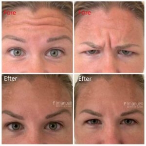 Botulinumtoxin för pannaoch argrynka En kvinna rynkar pannan och ögonbrynen före behandling med botulinumtoxin men efter behandling kan inte rynkor och veck framkallas