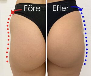 Butt lift Hip dips_body filler