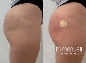 Butt lift profil volym med bodyfiller