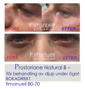 Tear trough Djup under ögat 3