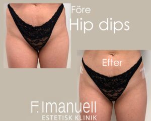 Volym till Hip dips_ bodyfiller