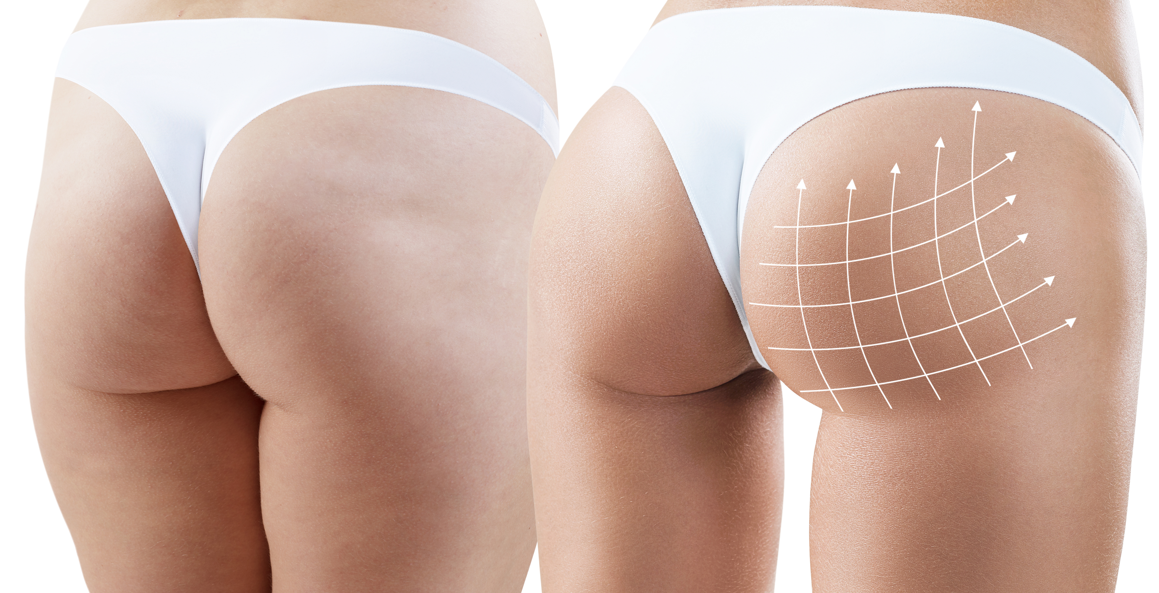 butt lift sidan
