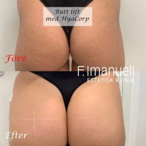 butt lift volym_HyaCorp bodyfiller